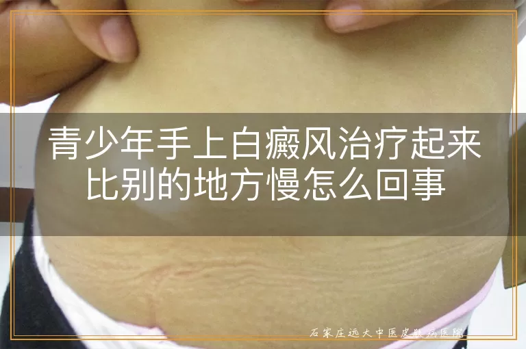 青少年手上白癜风治疗起来比别的地方慢怎么回事