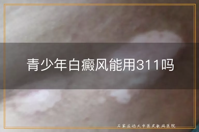 青少年白癜风能用311吗