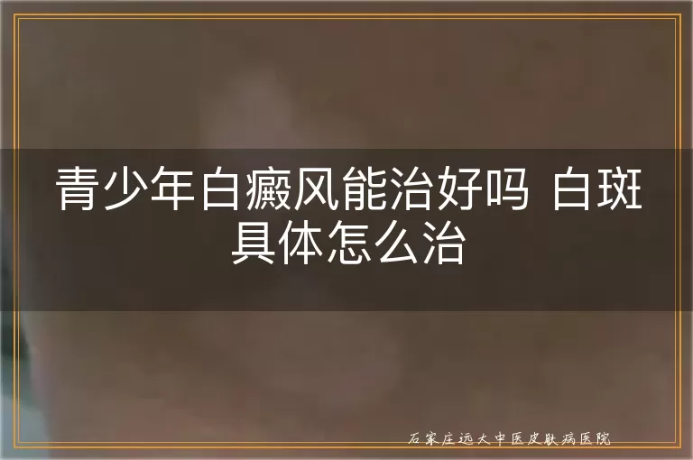 青少年白癜风能治好吗 白斑具体怎么治