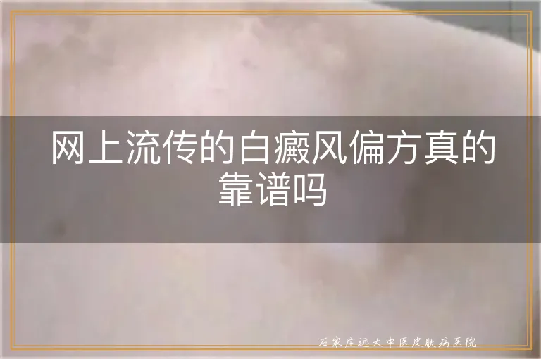 网上流传的白癜风偏方真的靠谱吗
