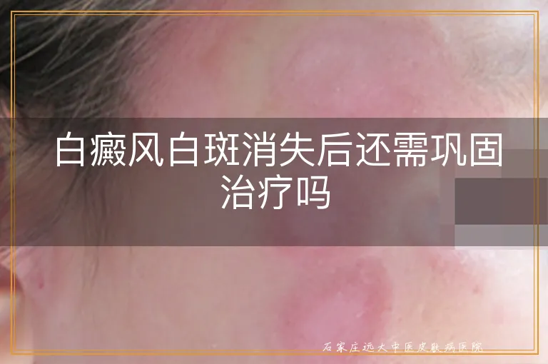 白癜风白斑消失后还需巩固治疗吗