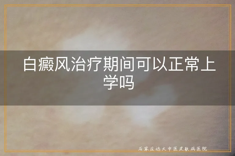 白癜风治疗期间可以正常上学吗