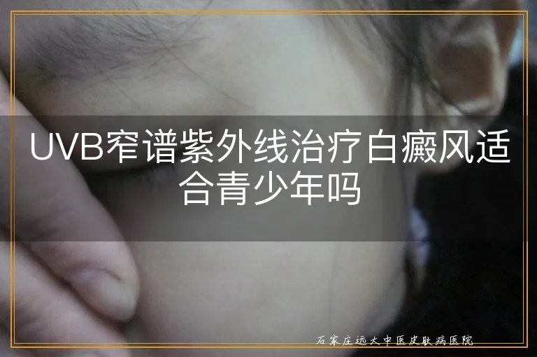 UVB窄谱紫外线治疗白癜风适合青少年吗