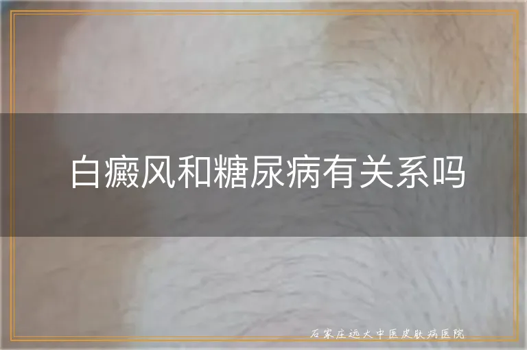 白癜风和糖尿病有关系吗