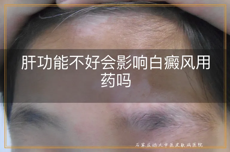肝功能不好会影响白癜风用药吗