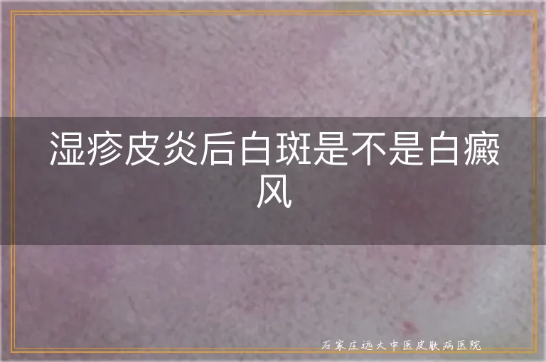 湿疹皮炎后白斑是不是白癜风