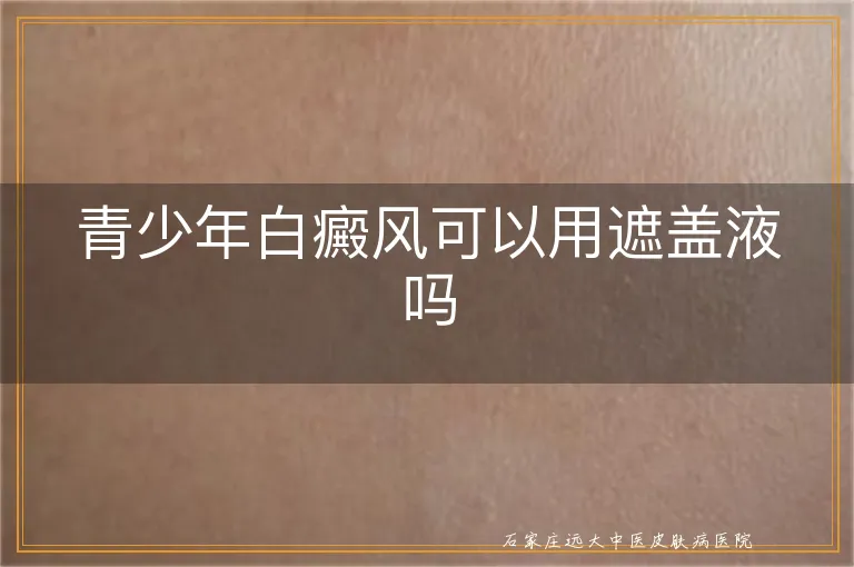 青少年白癜风可以用遮盖液吗