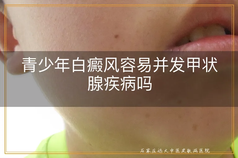青少年白癜风容易并发甲状腺疾病吗