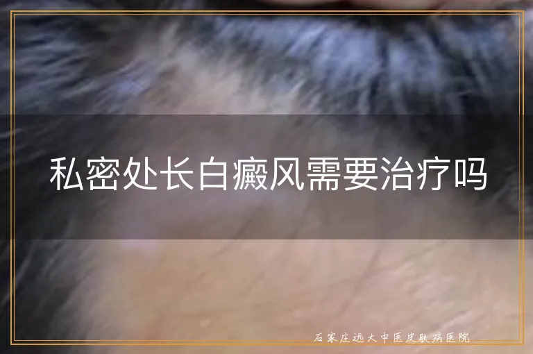 私密处长白癜风需要治疗吗