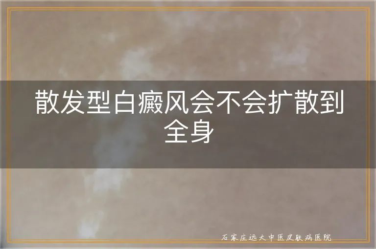 散发型白癜风会不会扩散到全身