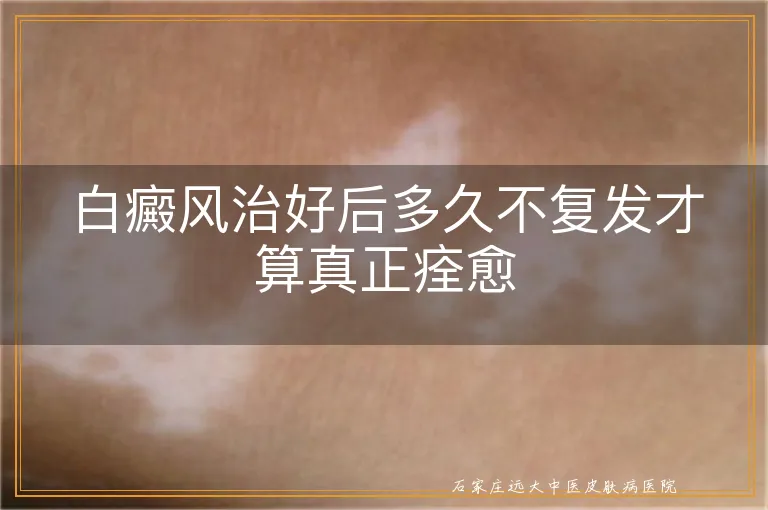 白癜风治好后多久不复发才算真正痊愈