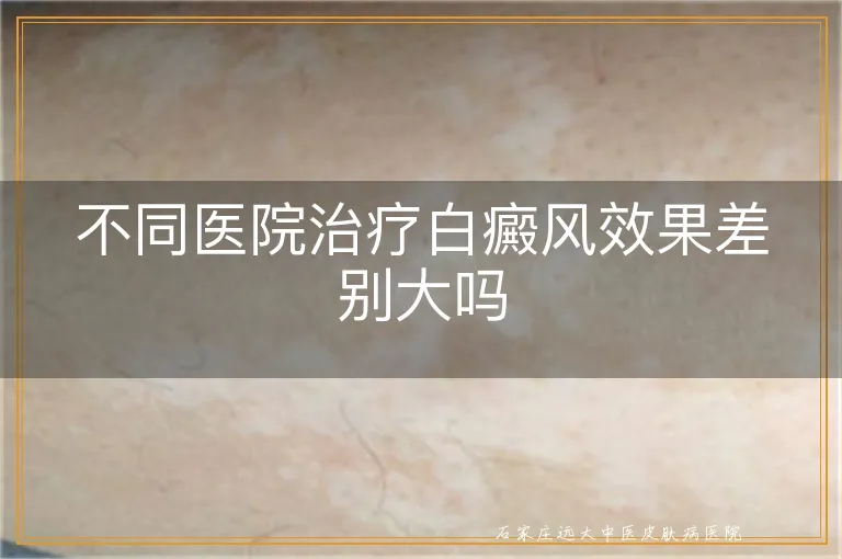 不同医院治疗白癜风效果差别大吗