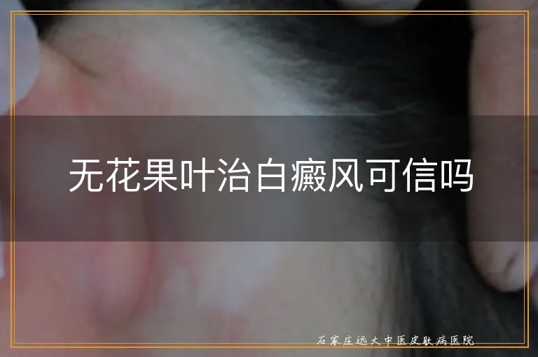 无花果叶治白癜风可信吗