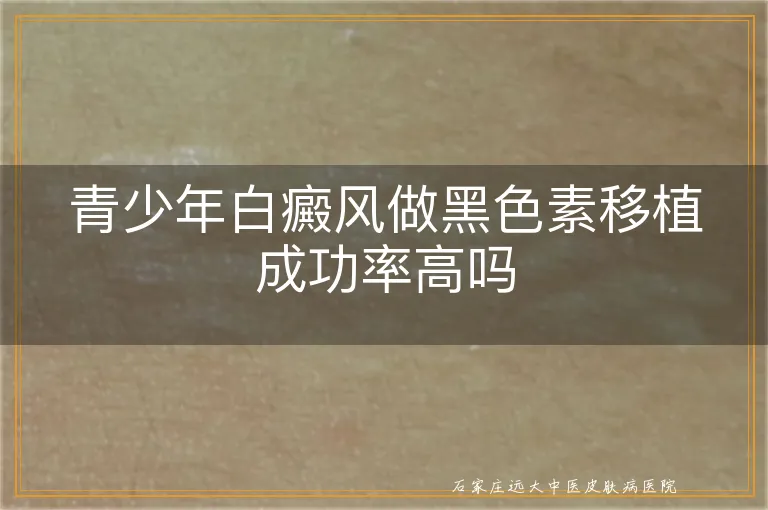 青少年白癜风做黑色素移植成功率高吗