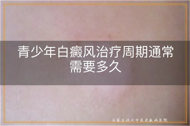青少年白癜风治疗周期通常需要多久