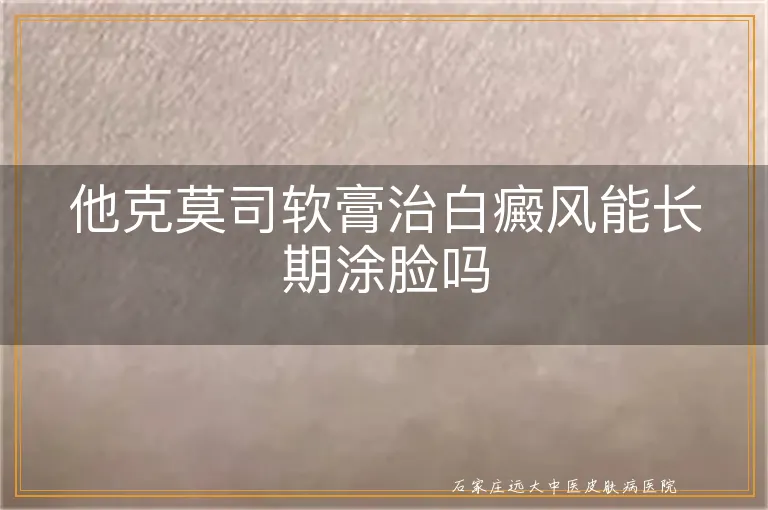他克莫司软膏治白癜风能长期涂脸吗