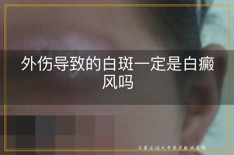 外伤导致的白斑一定是白癜风吗