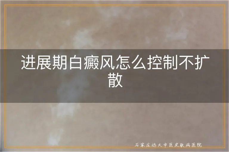 进展期白癜风怎么控制不扩散