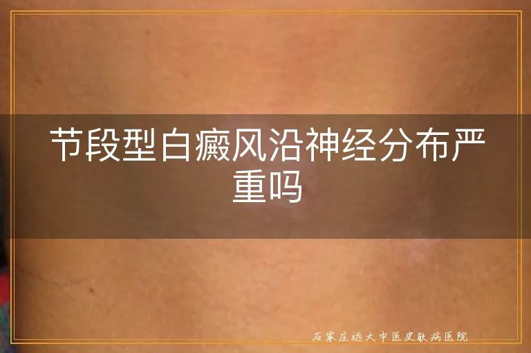 节段型白癜风沿神经分布严重吗