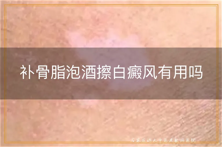 补骨脂泡酒擦白癜风有用吗