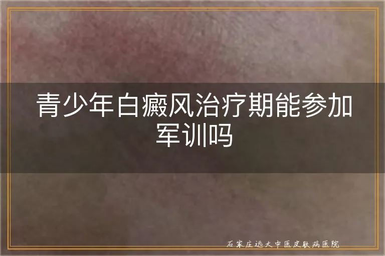 青少年白癜风治疗期能参加军训吗