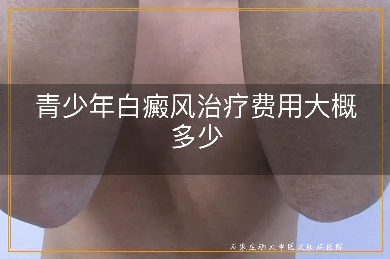 青少年白癜风治疗费用大概多少