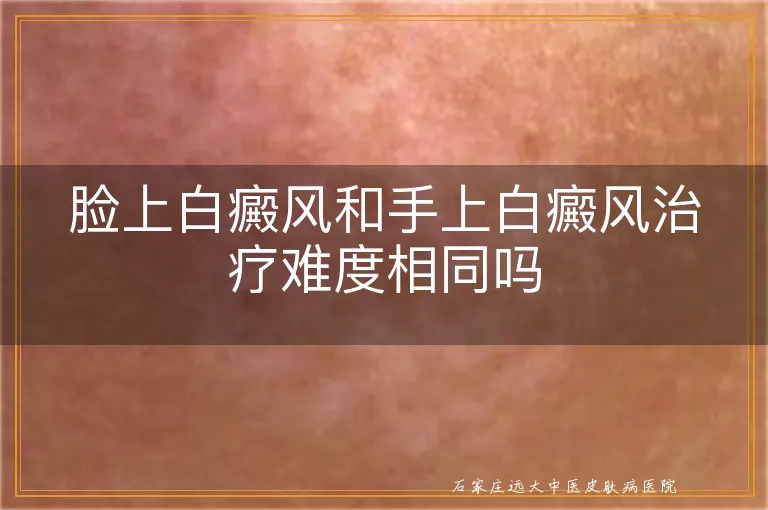 脸上白癜风和手上白癜风治疗难度相同吗
