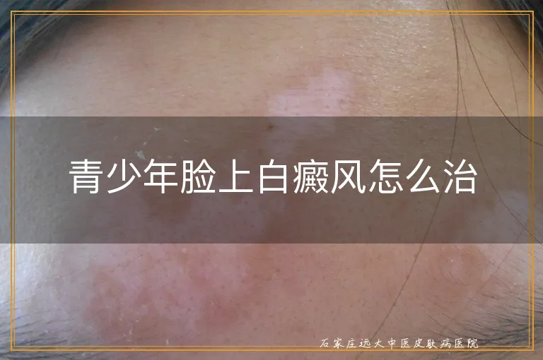 青少年脸上白癜风怎么治