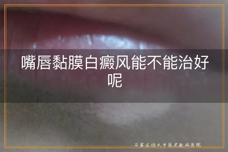 嘴唇黏膜白癜风能不能治好呢