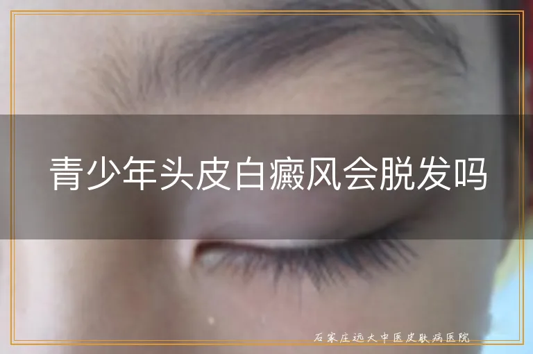 青少年头皮白癜风会脱发吗