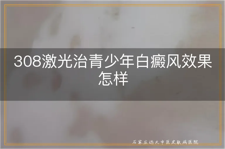 308激光治青少年白癜风效果怎样