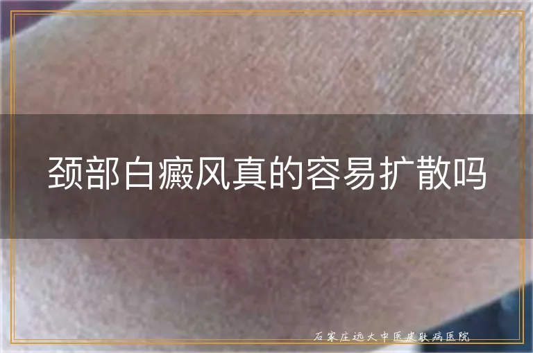 颈部白癜风真的容易扩散吗