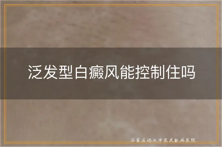 泛发型白癜风能控制住吗