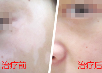 石家庄白癜风去哪治疗要注意什么