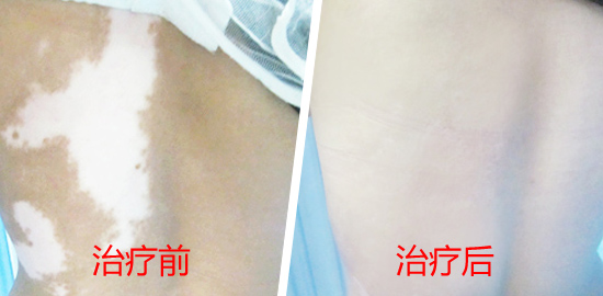 石家庄白癜风的治疗有什么要注意的呢