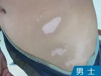 男性白癜风白斑治疗案例